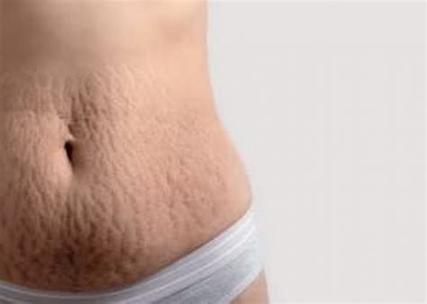 Menghilangkan Stretch Mark Secara Alami Dengan Bahan Ini Yang Mudah