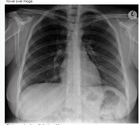 Ccs Radiology Chest X Ray Ultrasound Cardiograph Flashcards Quizlet