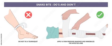 Snake Bite First Aid Poster