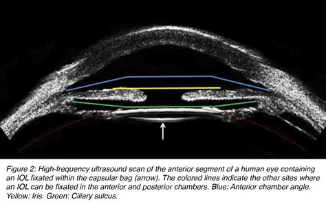 Intraocular Lenses For Cataract Surgery By Jason Nguyen And Liliana