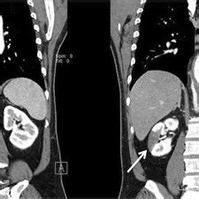 Sagittal View Of The Preoperative Contrast Enhanced Computed Tomography