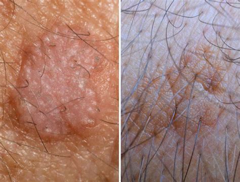 Rimedi Naturali Per La Cheratosi Attinica Derma Point