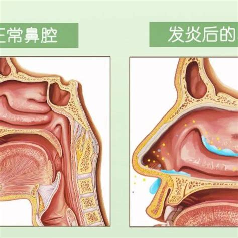 浅谈儿童过敏性鼻炎的用药难题—对抗过敏、增强免疫双管齐下 治疗 患儿 呼吸道