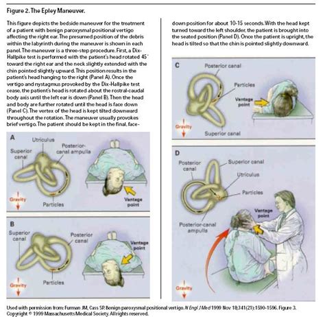 Vestibular Neuritis Exercises