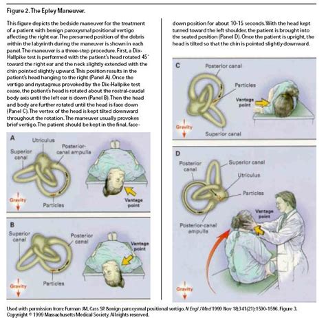 Neuritis: Exercises For Vestibular Neuritis