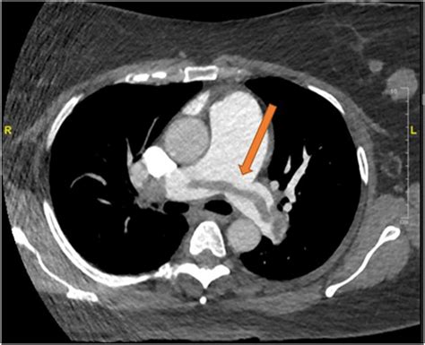 Tromboembolismo Pulmonar E Ecocardiografia Aten O Para A Janela