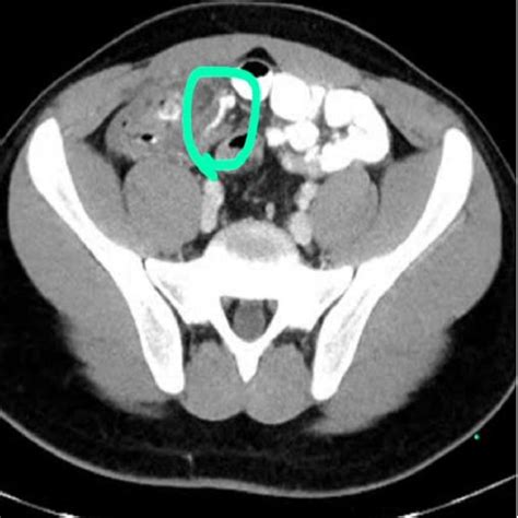 Cect Scan Of The Abdomen Pelvis Showing The Appendix To Be Download Scientific Diagram