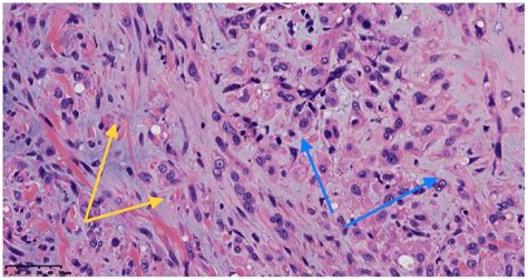 Areas Of Epithelioid Cells Blue Arrow And Spindle Cells Yellow