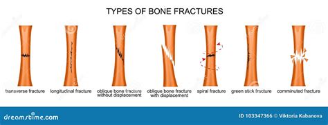 Tipi Di Fratture Illustrazione Vettoriale Illustrazione Di Dolore 103347366