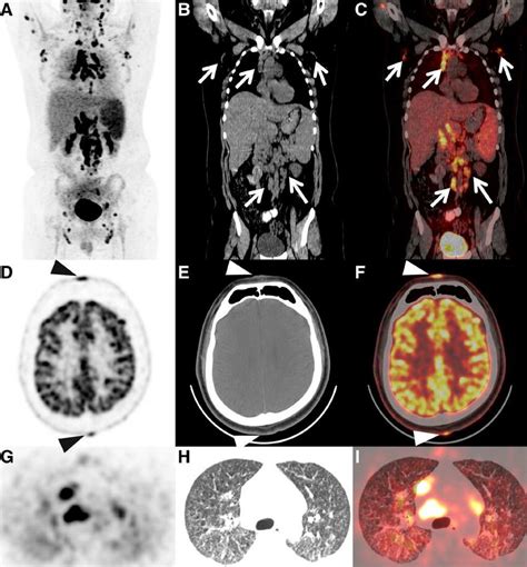 Mip Image A Showed Multiple Hypermetabolic Lymph Nodes In The Upper Download Scientific