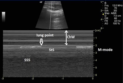 Picture Of Pneumothorax M Mode Ultrasound