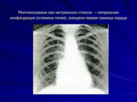 Приобретенные пороки сердца - презентация онлайн