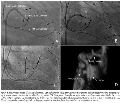 Percutaneous Repair Of Anterior Mitral Leaflet Perforation