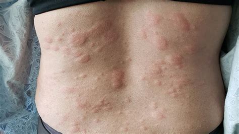 Hives Symptoms: How You Know It’s Really Hives | Everyday Health