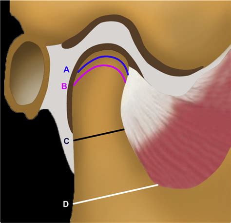 Four Types Of Condylar Resection According To The Vertical Position Of Download Scientific