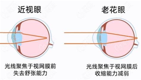 近视和老花能相互抵消吗？不能，但老花眼和近视眼可以一并做手术解决！ 美佳社区