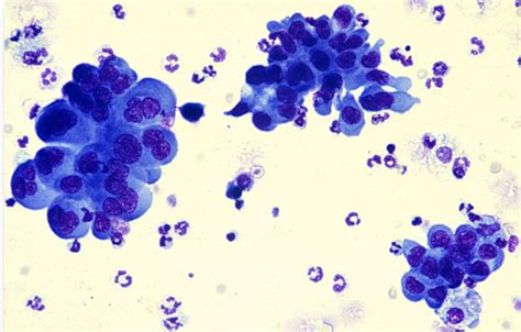 Clin Path L42 Cytopathology Of Inflammation And Neoplasia Flashcards