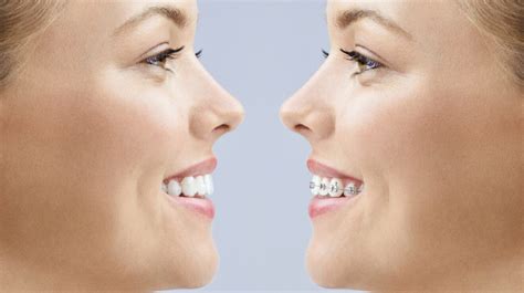 Braces Vs Invisalign Dr Vivaldis Guide To Confident Smiles