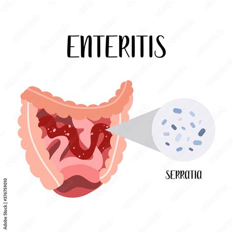 enteritis inflammation   small intestine serratia bacteria gut