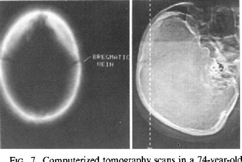 Figure 6 From Computerized Tomography Of Cranial Sutures Part 1