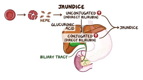 Unconjugated Hyperbilirubinemia Causes Symptoms Diagnosis And