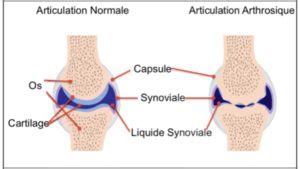 Larthrose De L Paule Omarthrose Clinique De L Paule Du Coude