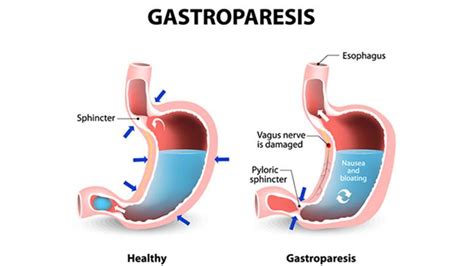 Diabetic Gastroparesis Symptoms Complications Treatments And More Entirely Health