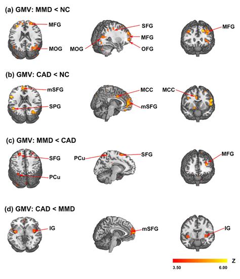 Comparison Of Gray Matter Volume Mri T1 Among Patients And Normal