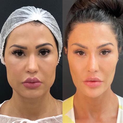 Gracyanne Barbosa Mostra Antes E Depois De Procedimentos No Rosto