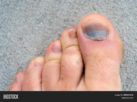 Toe Injury Bruise Image Photo Free Trial Bigstock