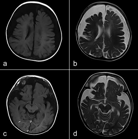 A B Atrophy Of Bilateral Fronto Parietal Lobes More On The Right