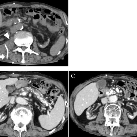 A The Right Retroperitoneal Cystic Lesion Was Drained To Control