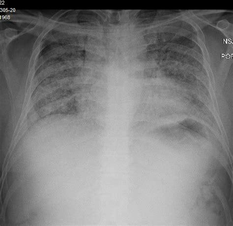 Covid 19 And Spontaneous Pneumomediastinum A Case Series