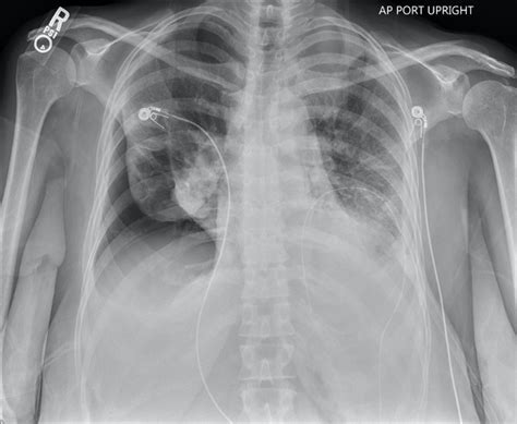 Apical Pneumothorax Chest X Ray