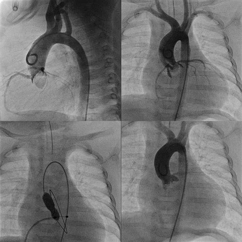 7 Intracardiac echocardiography for evaluation of the pulmonary valve ...