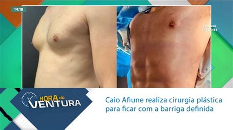 Caio Afiune realiza cirurgia plástica para ficar a barriga definida