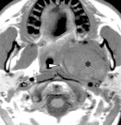 Parapharyngeal Space Mass