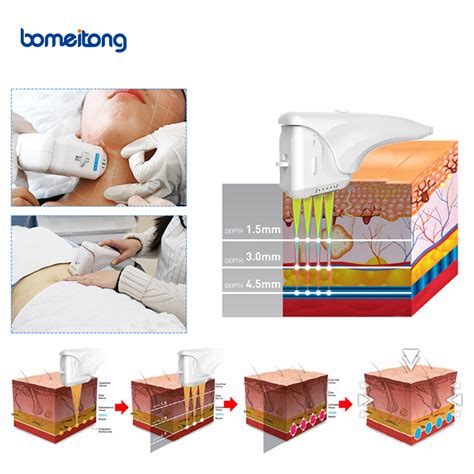 Hello Skin Hifu Focal Therapy Mini Original Ultra Machine From China