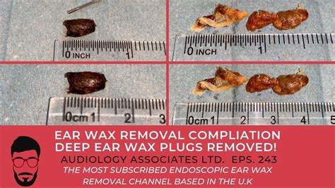 Ear Wax Removal Compilation Deep Ear Wax Plugs Removed Ep 243 Youtube