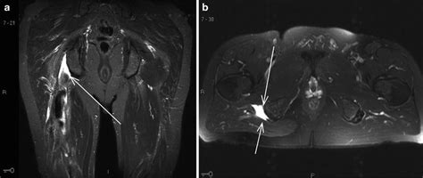 Proximal Hamstring Ultrasound