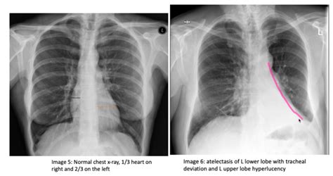 Cxr Consolidation Or Atelectasis — Maimonides Emergency Medicine
