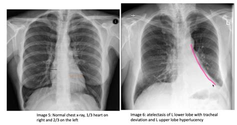 CXR Consolidation Or Atelectasis Maimonides Emergency Medicine