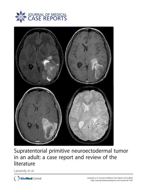 Pdf Supratentorial Primitive Neuroectodermal Tumor In An Adult A Case Report And Review Of