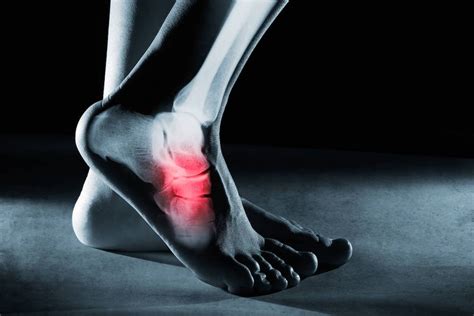 How To Treat A Broken Foot A Podiatrist S Guide