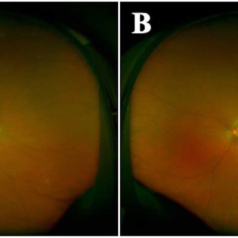 Fundus Photography Of The Right Eye A And Left Eye B With An