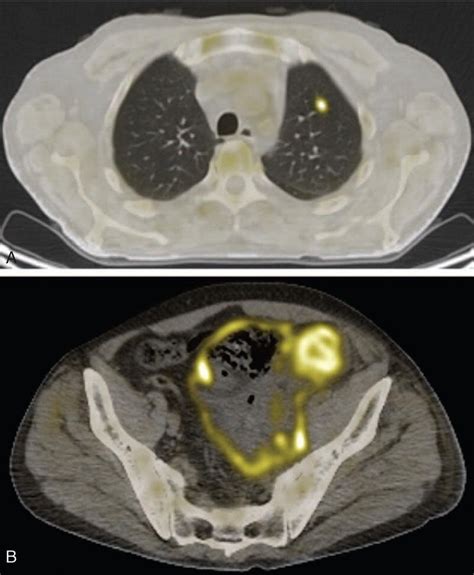 Fusion Positron Emission Tomography Computed Tomography Images Showing