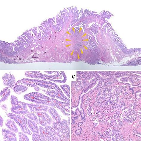 Figure10histological View Of The Resected Specimen A Low Power Download Scientific Diagram