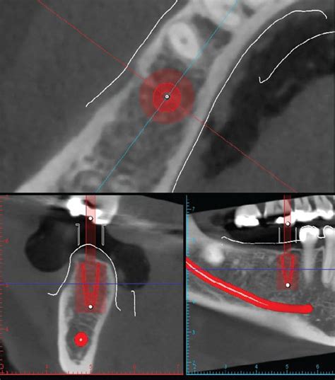 Utility Of Cone Beam Imaging In Periodontics And Implant Therapy