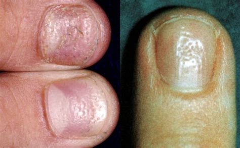 Psoriasis Des Ongles Sur Les Mains Et Les Pieds Causes Diagnostic Et