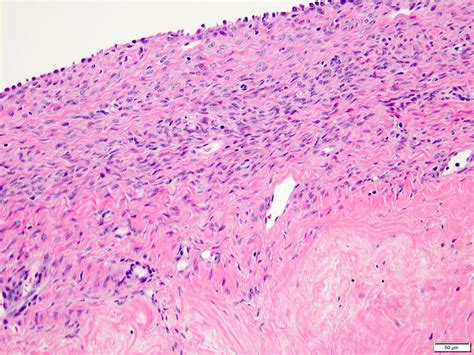 Pathology Outlines Mixed Epithelial And Stromal Tumor